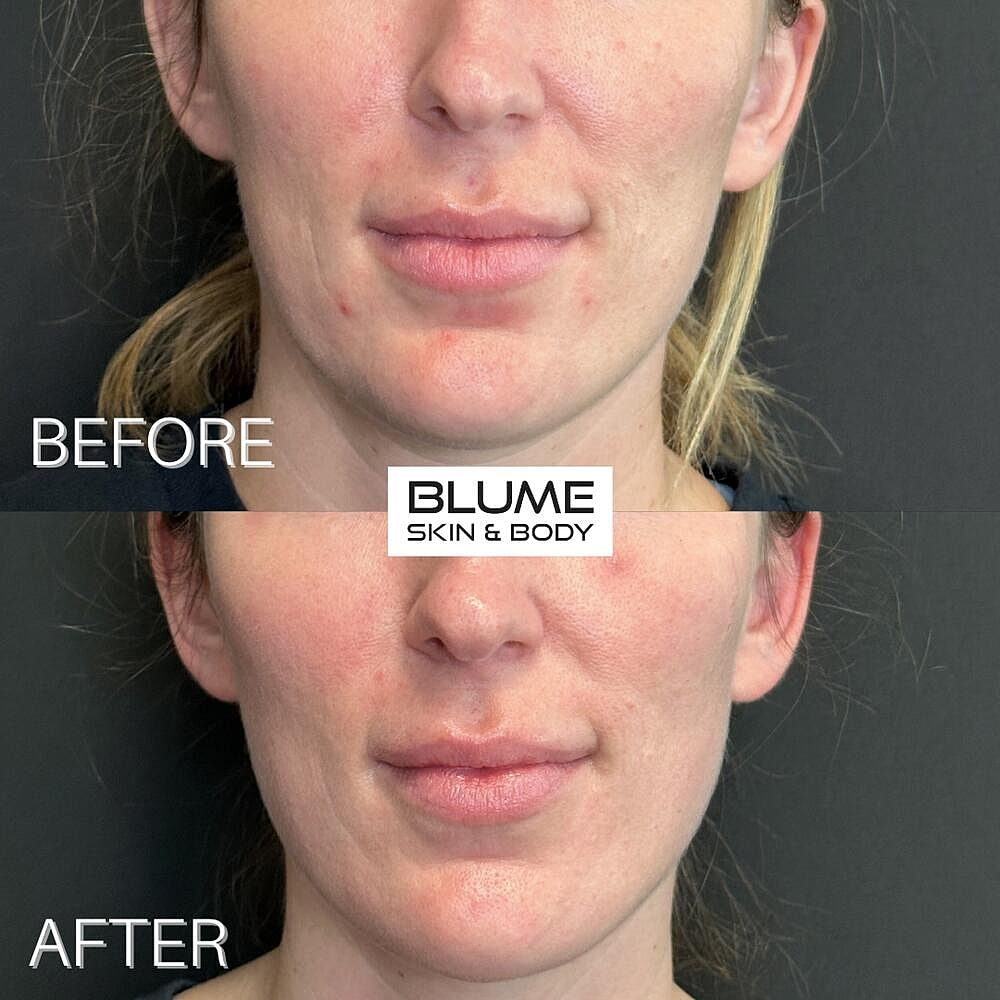 Dermal Fillers Before & After