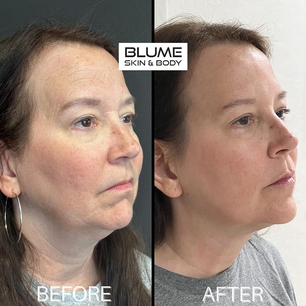 Dermal Fillers Before & After