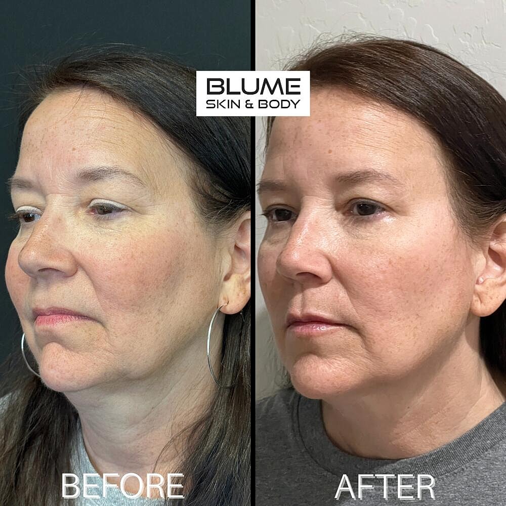 Dermal Fillers Before & After