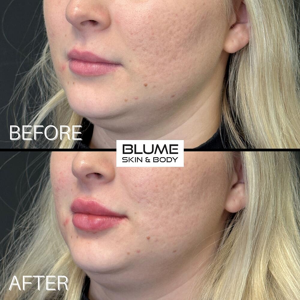 Dermal Fillers Before & After