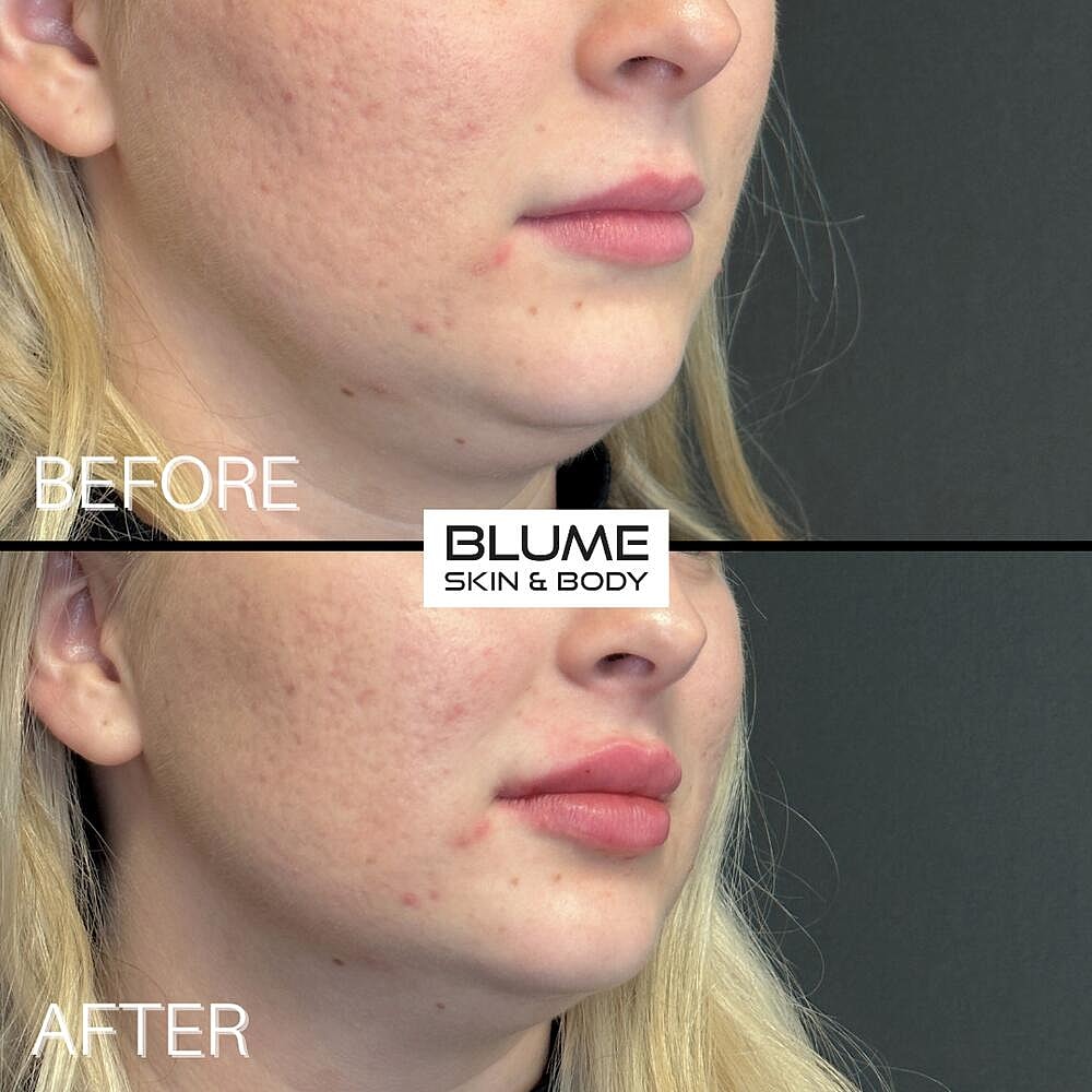 Dermal Fillers Before & After