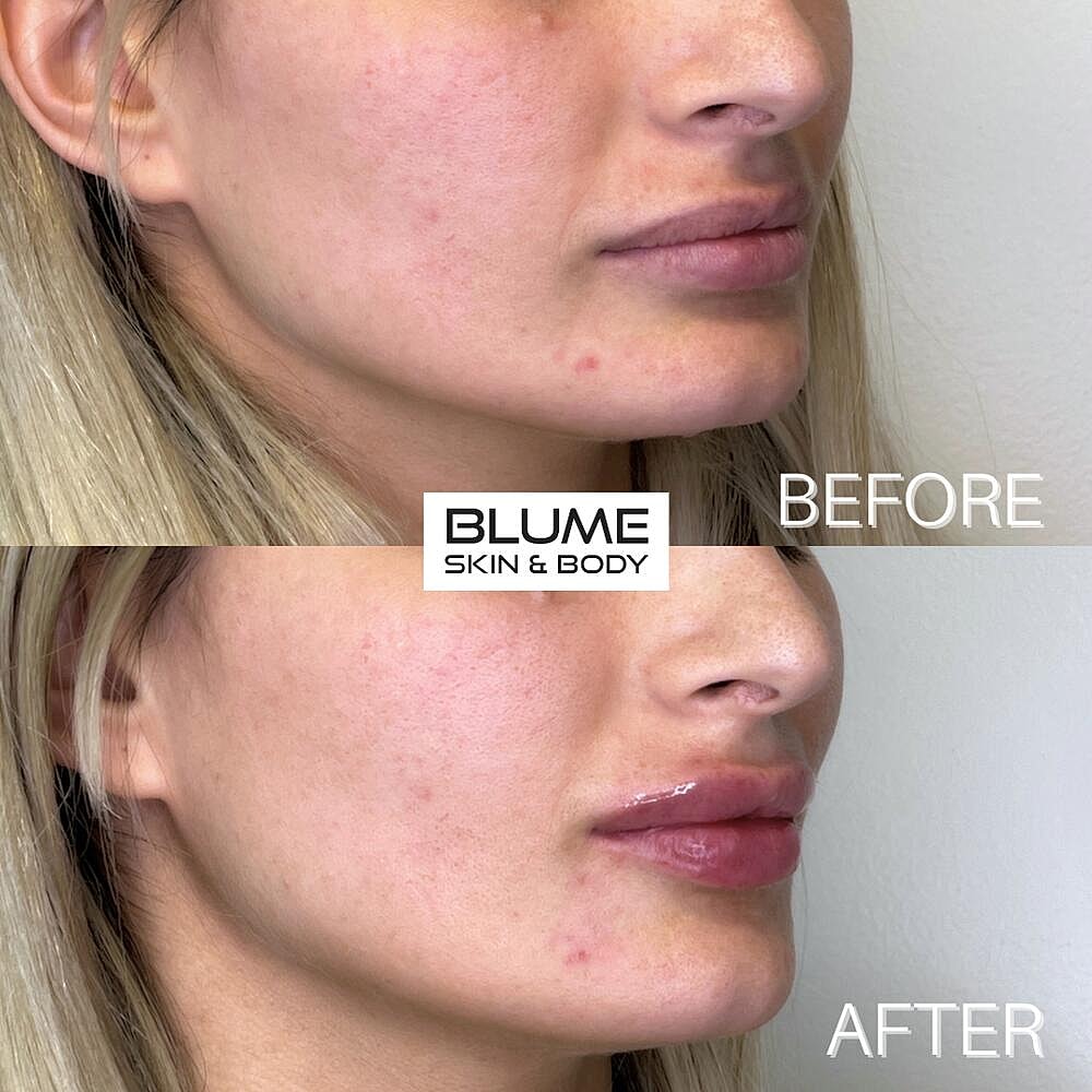 Dermal Fillers Before & After
