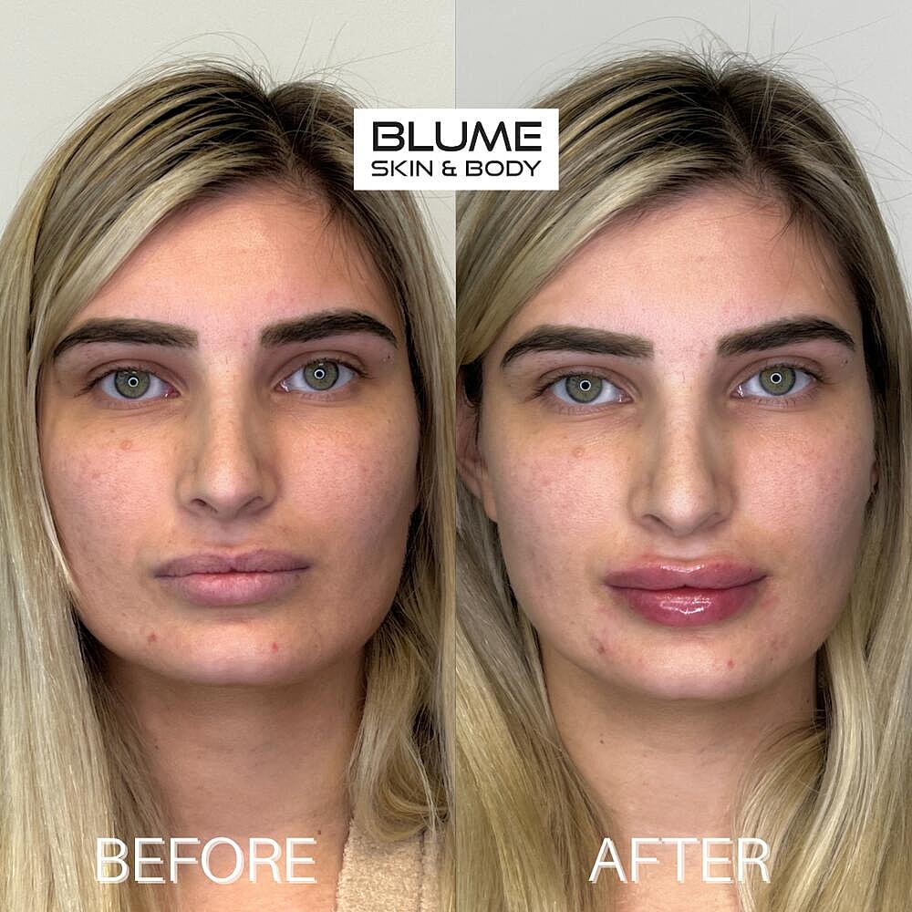 Dermal Fillers Before & After