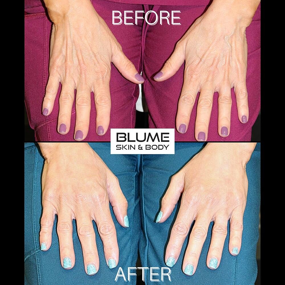 Dermal Fillers Before & After