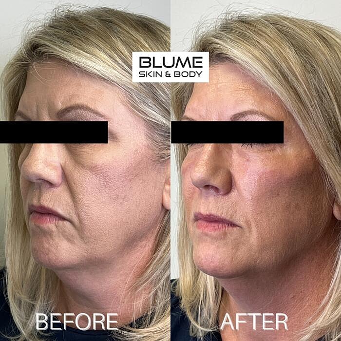 Dermal Fillers Before & After