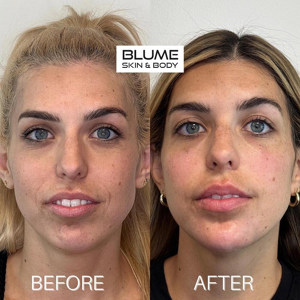 Dermal Fillers Before & After