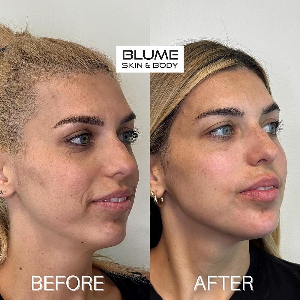 Dermal Fillers Before & After