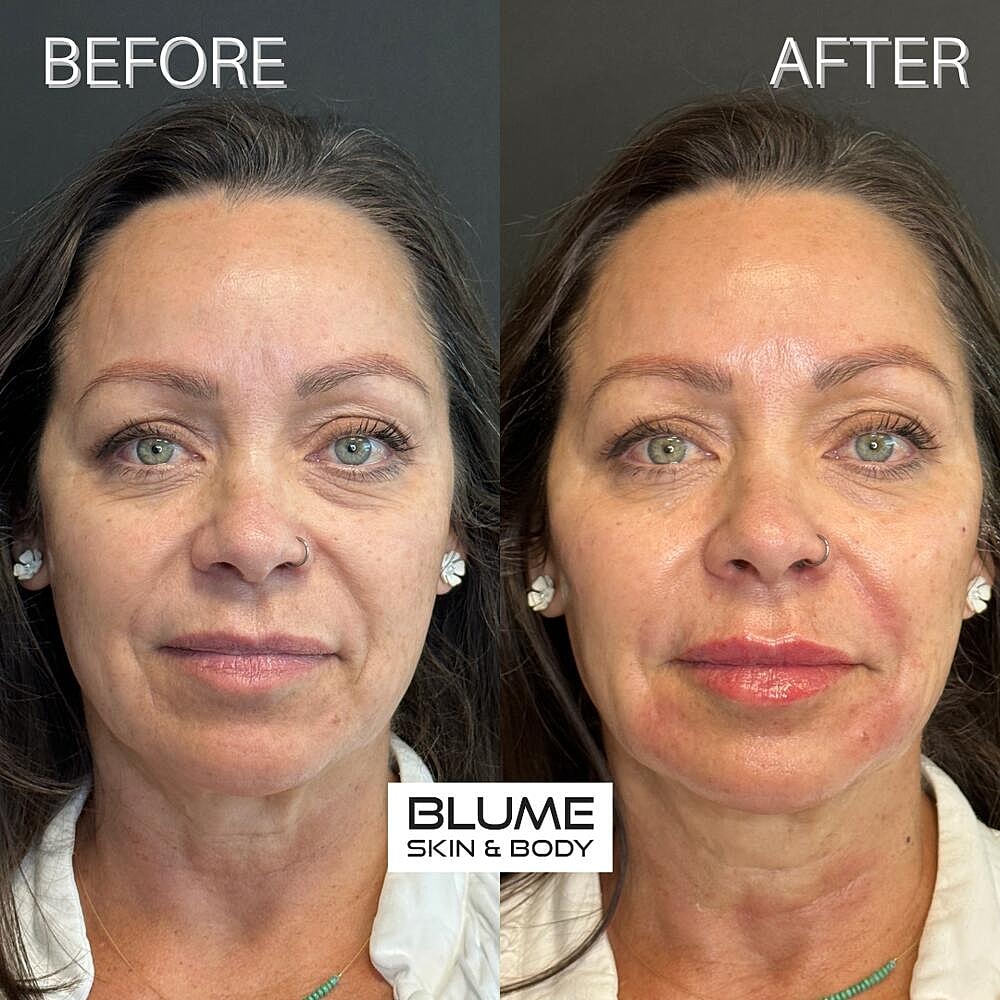 Dermal Fillers Before & After
