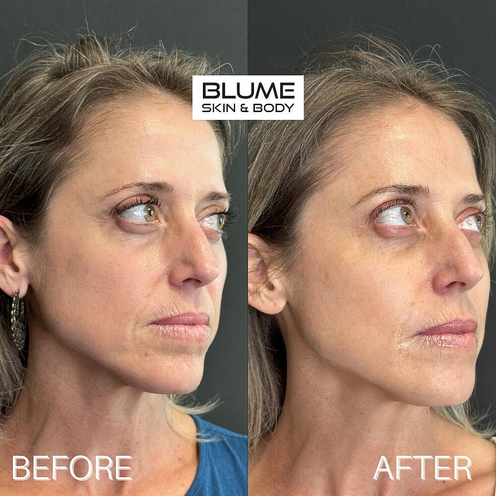 Dermal Fillers Before & After