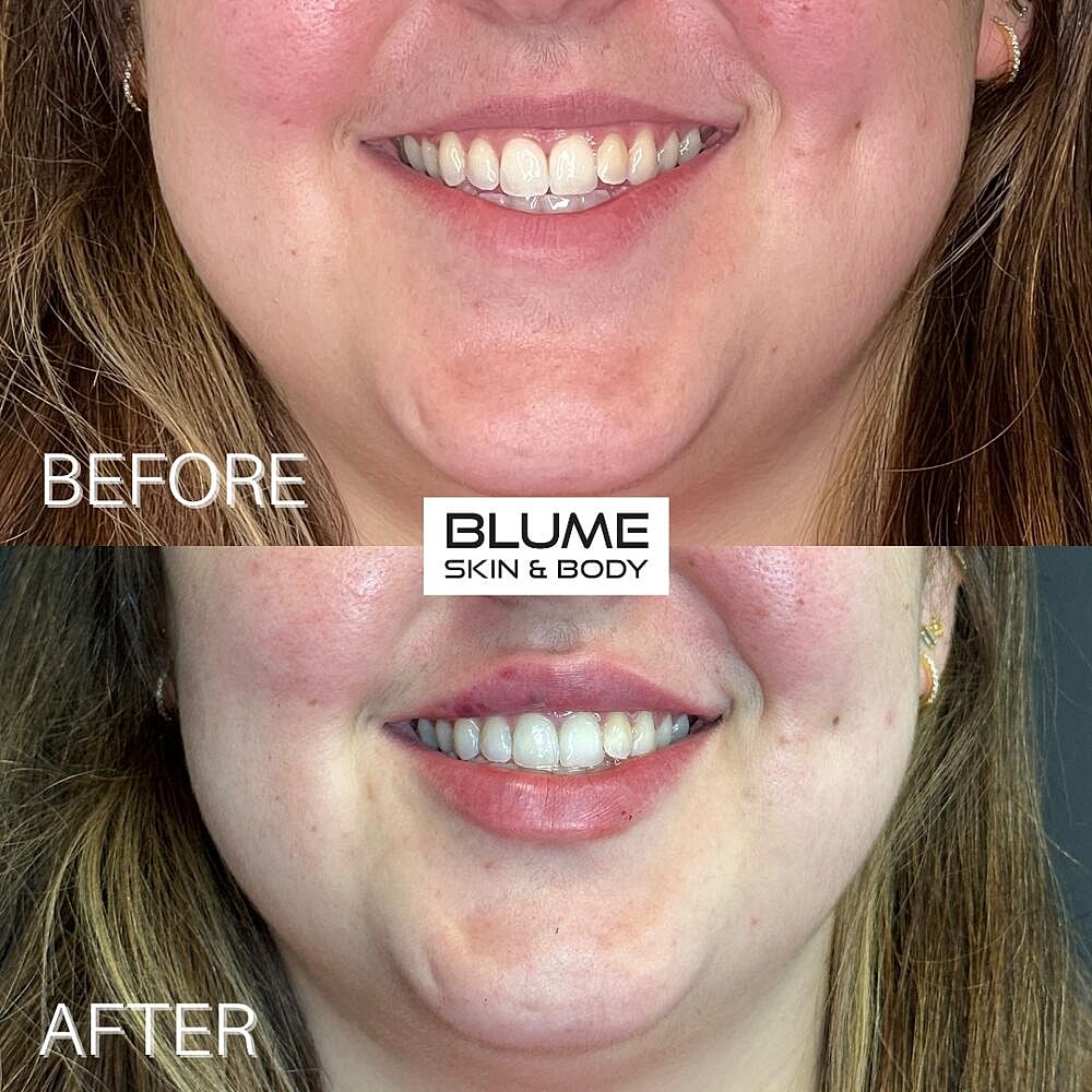 Dermal Fillers Before & After