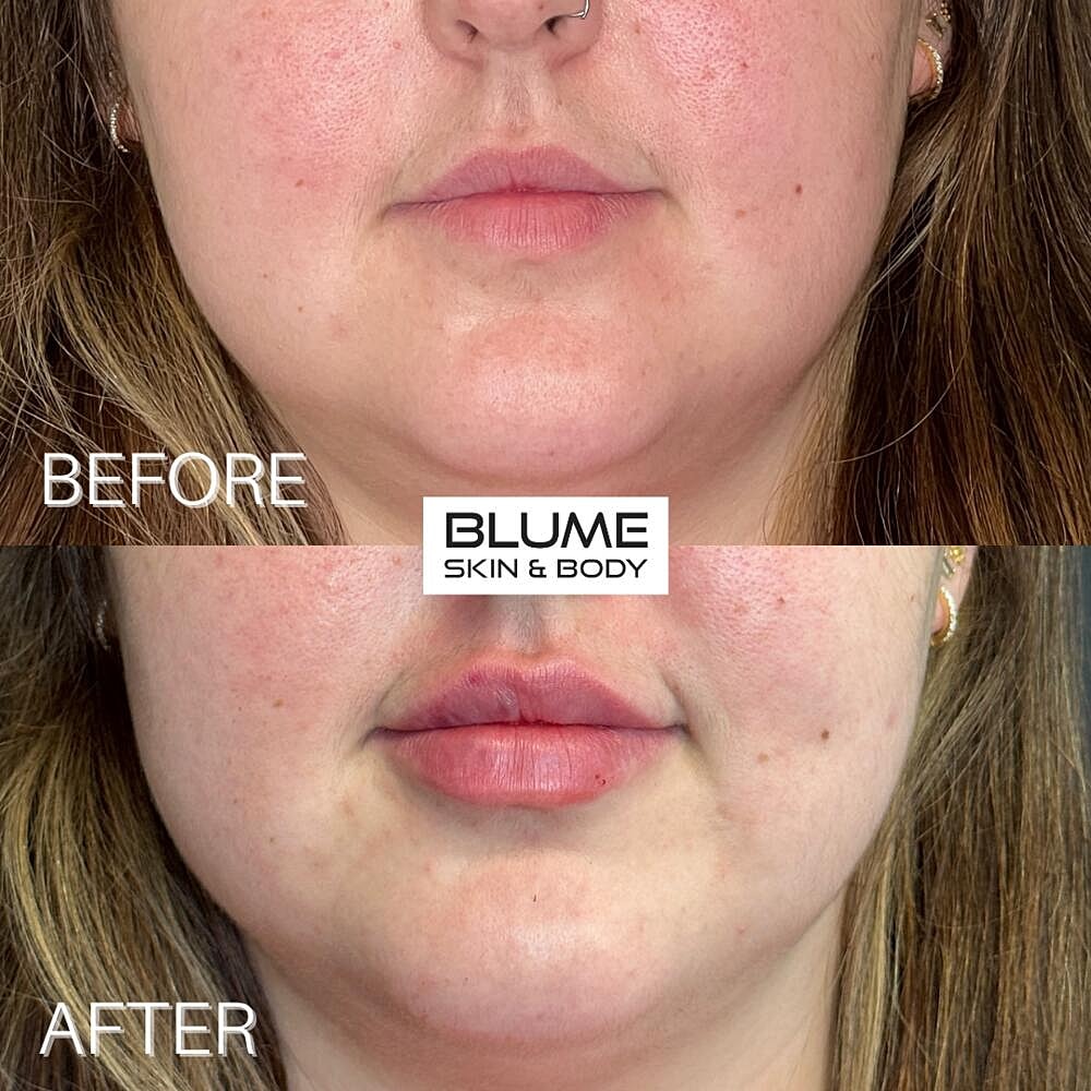 Dermal Fillers Before & After