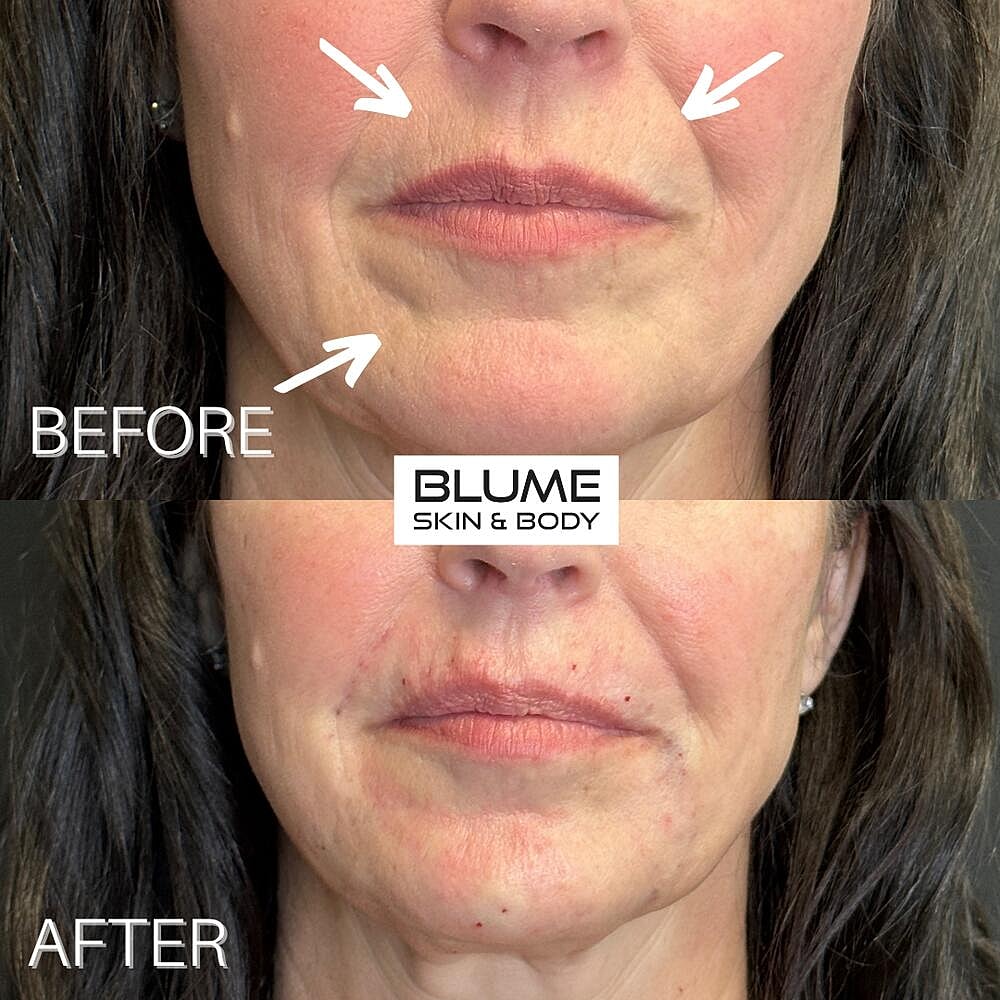 Dermal Fillers Before & After