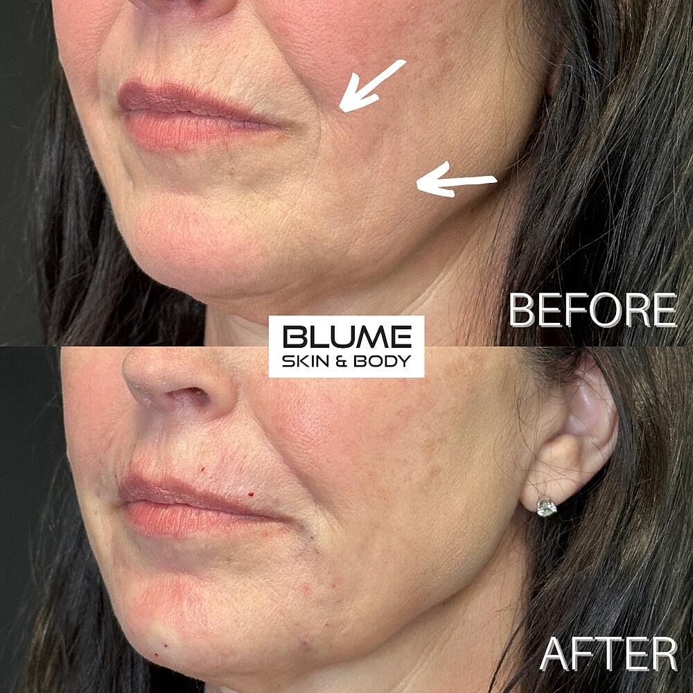 Dermal Fillers Before & After