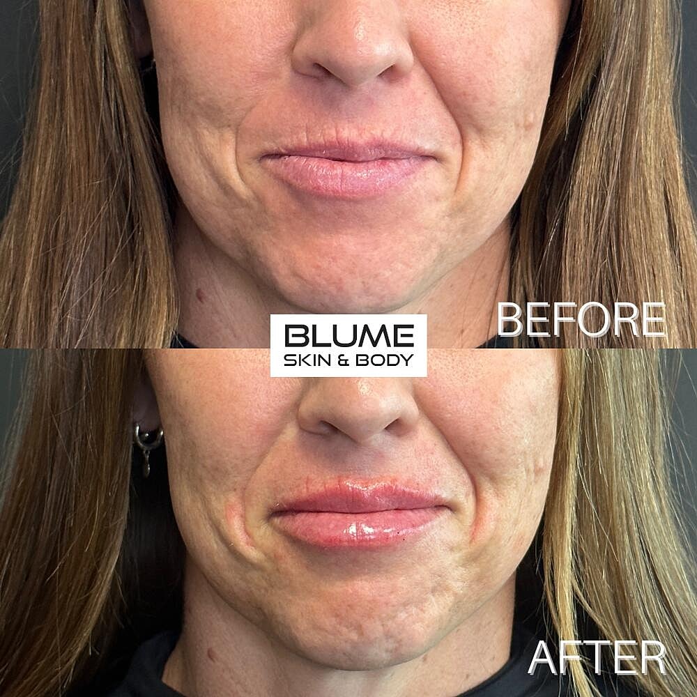 Dermal Fillers Before & After