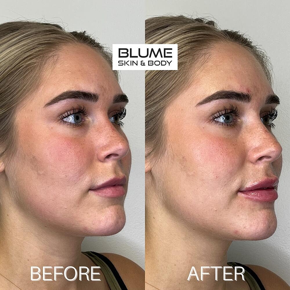 Dermal Fillers Before & After