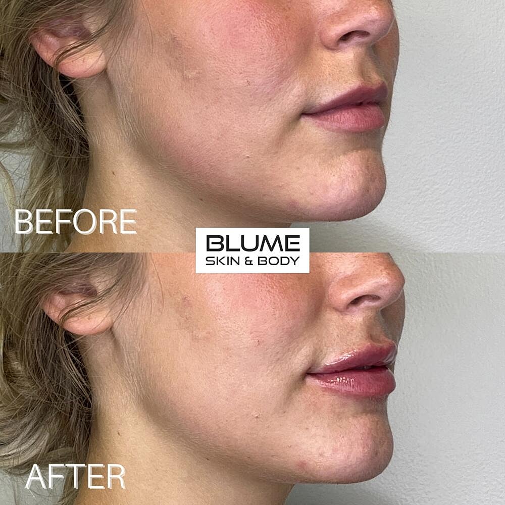 Dermal Fillers Before & After