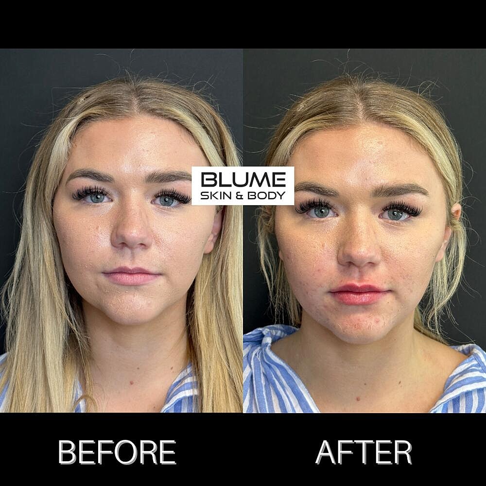 Dermal Fillers Before & After