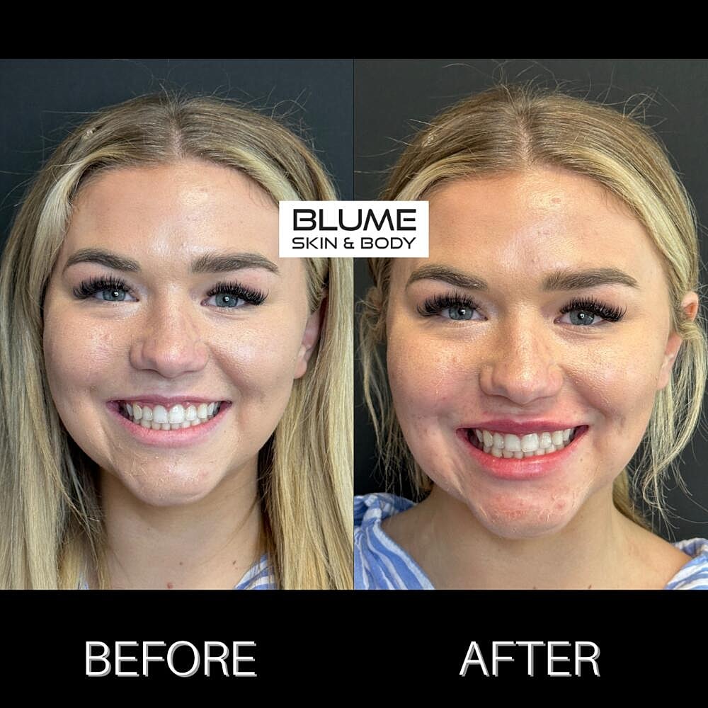 Dermal Fillers Before & After