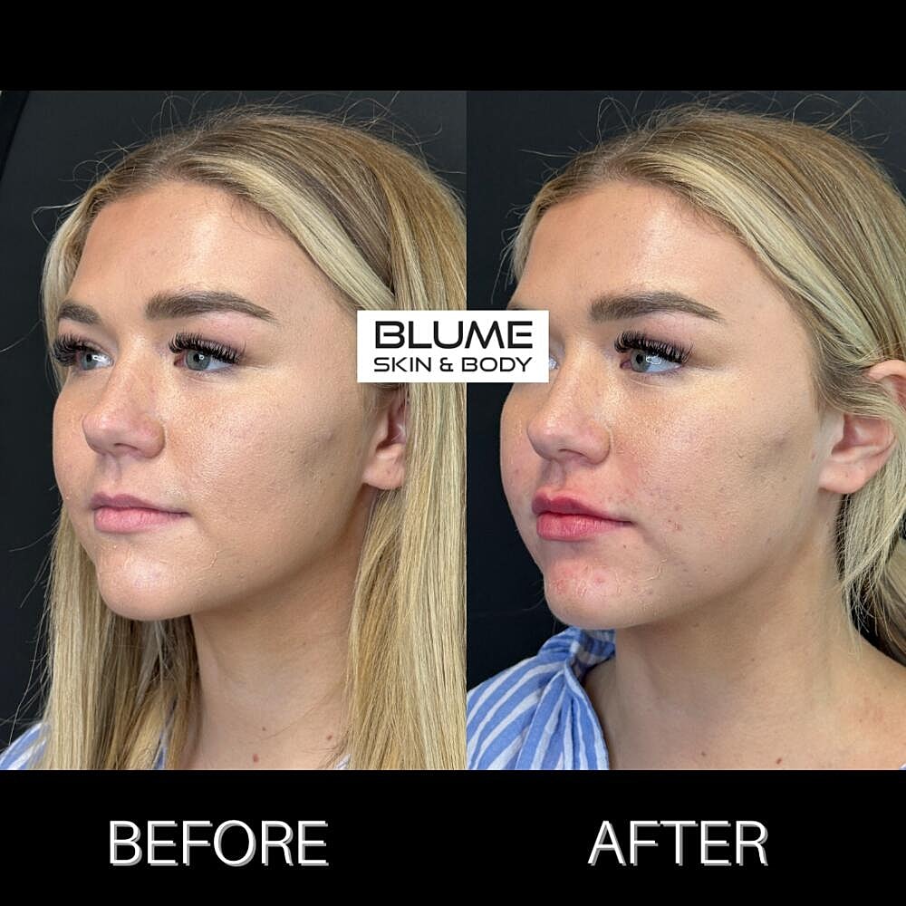 Dermal Fillers Before & After