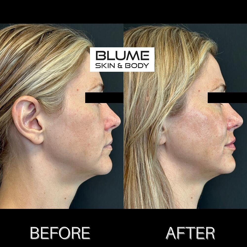 Dermal Fillers Before & After