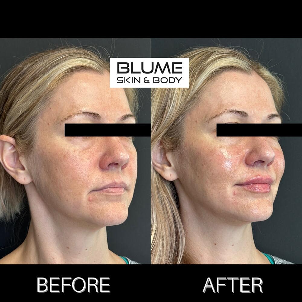 Dermal Fillers Before & After