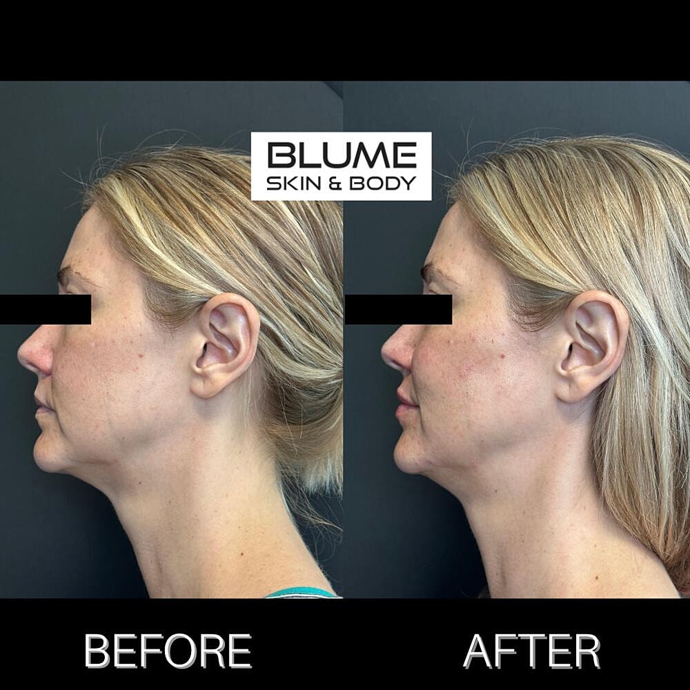 Dermal Fillers Before & After