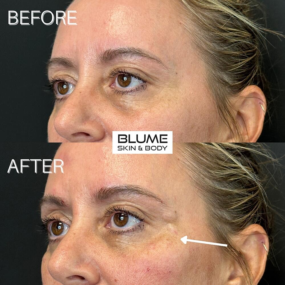 Dermal Fillers Before & After