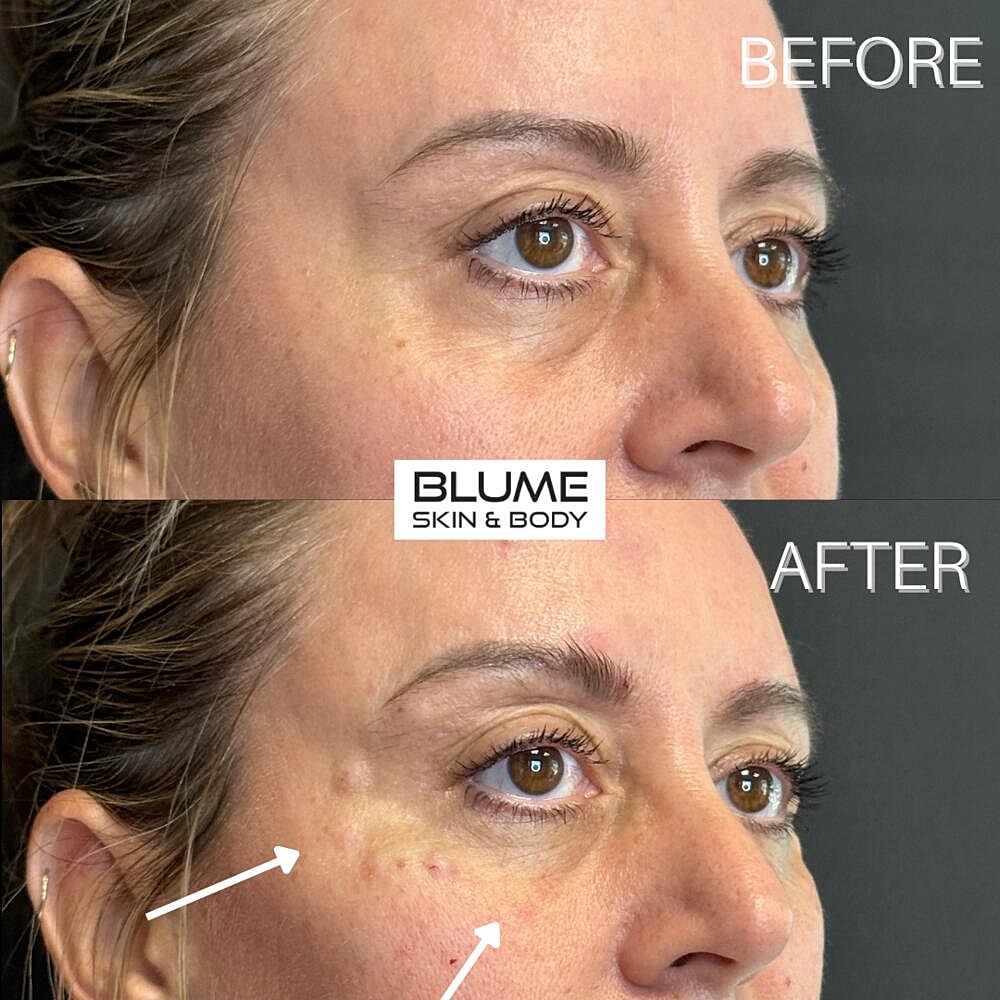 Dermal Fillers Before & After