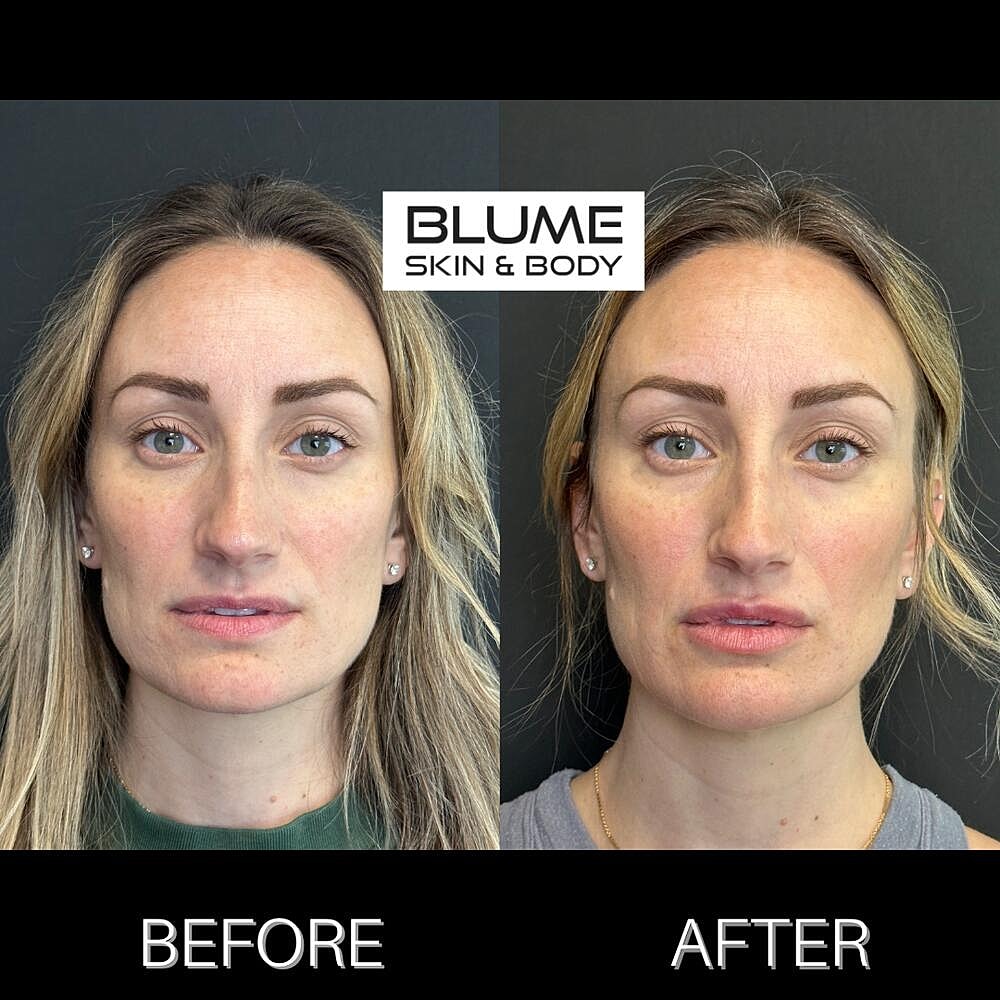 Dermal Fillers Before & After