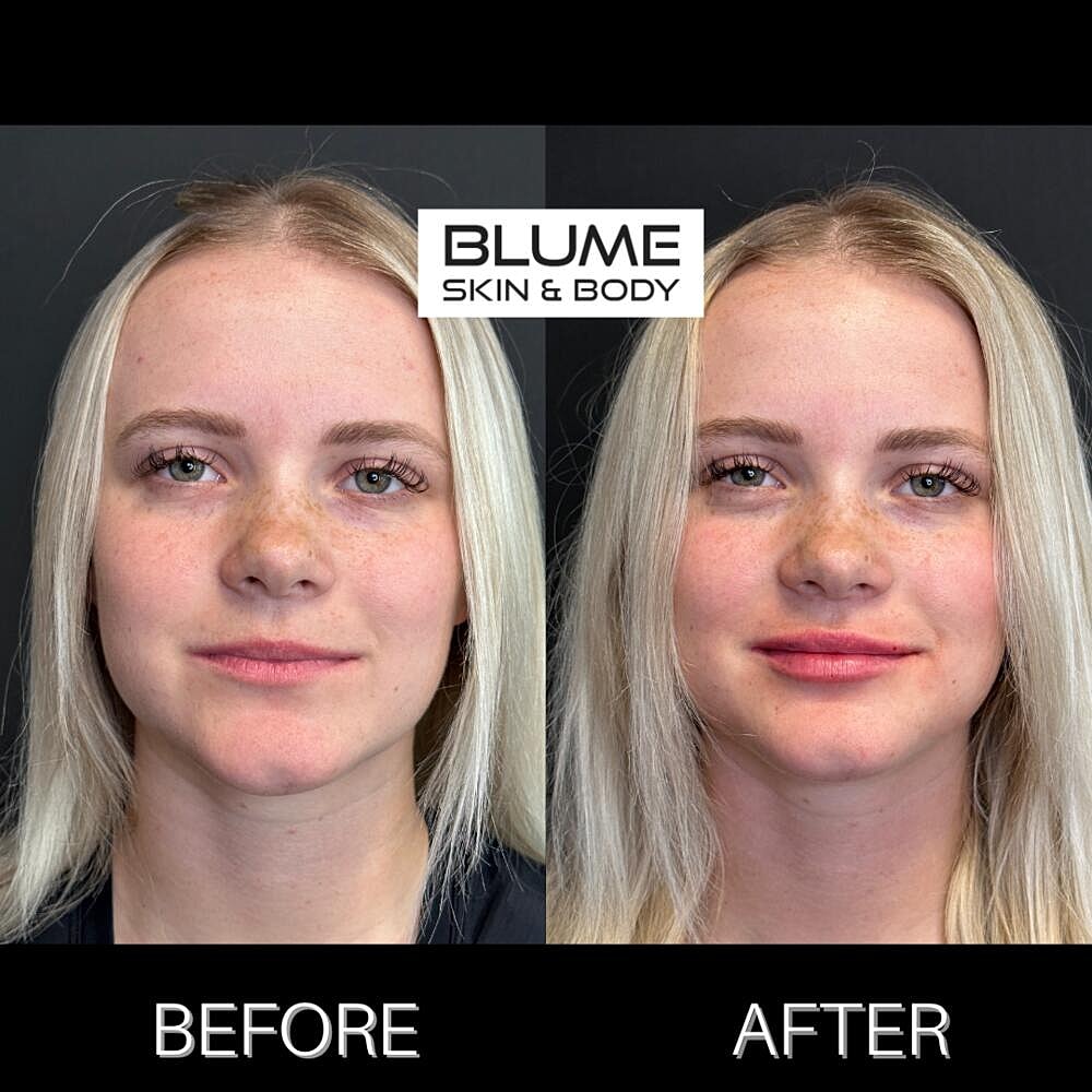 Dermal Fillers Before & After