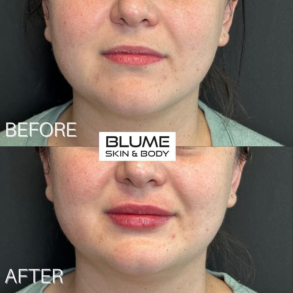 Dermal Fillers Before & After