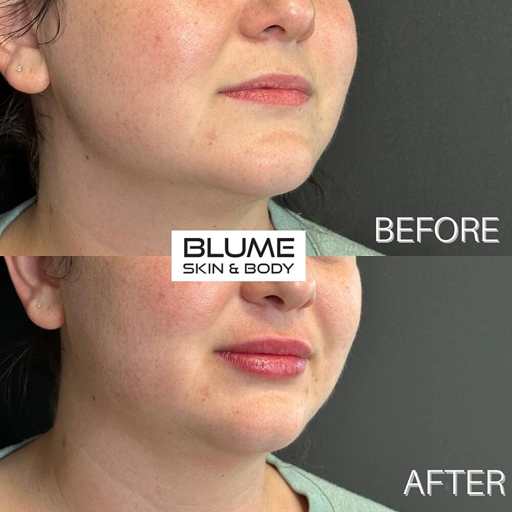 Dermal Fillers Before & After