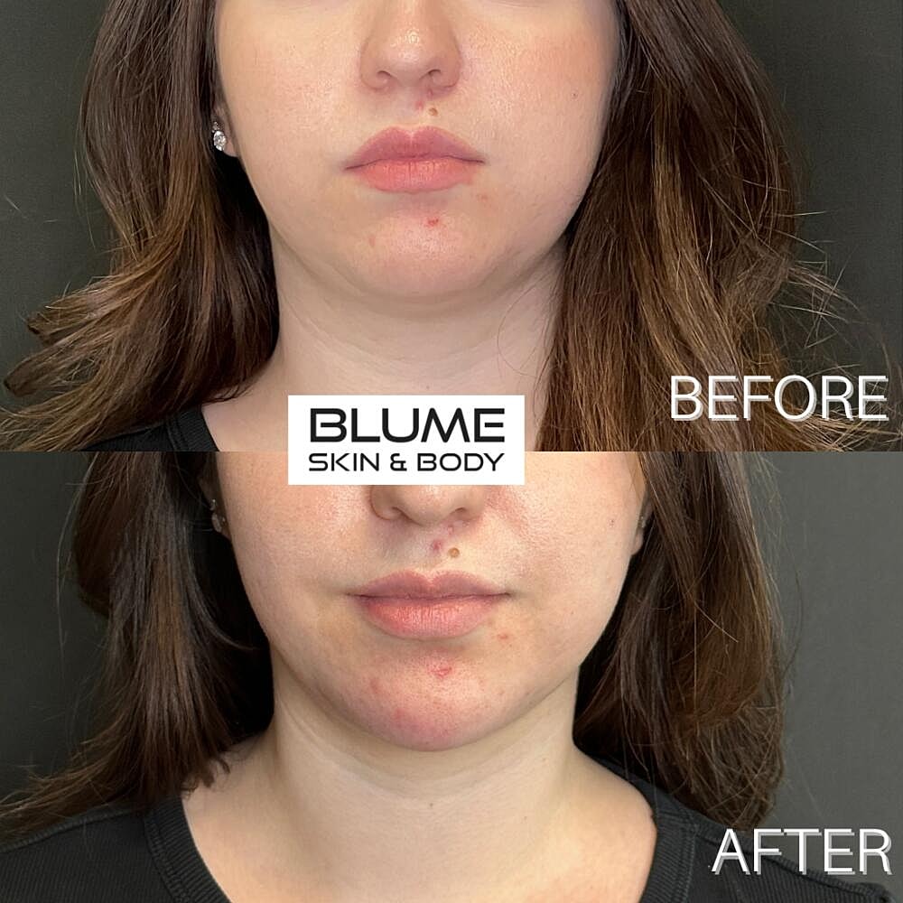 Dermal Fillers Before & After