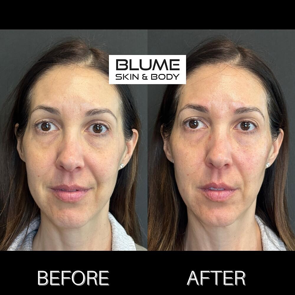 Dermal Fillers Before & After