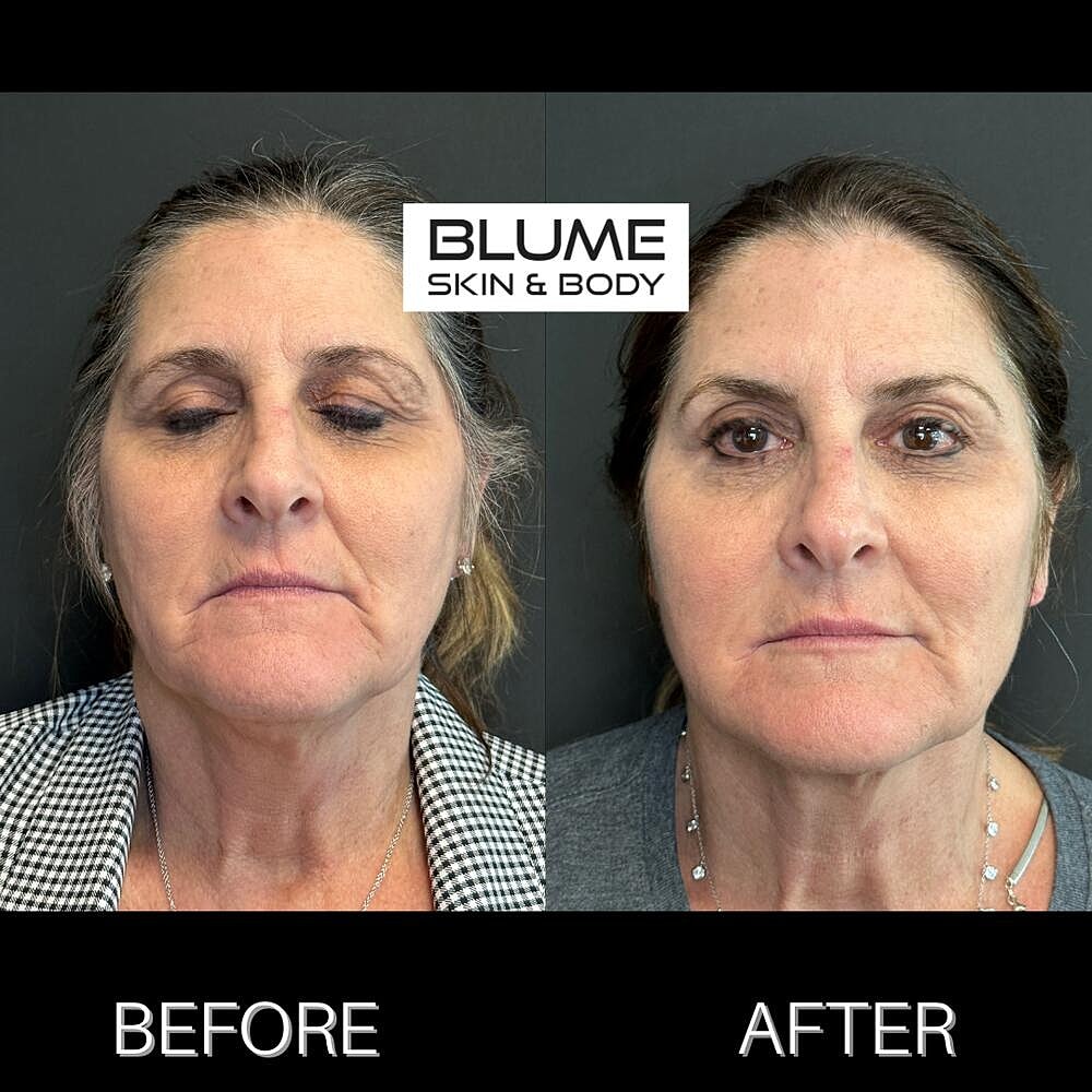 Dermal Fillers Before & After