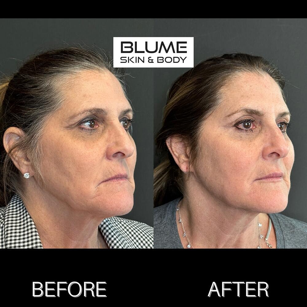 Dermal Fillers Before & After