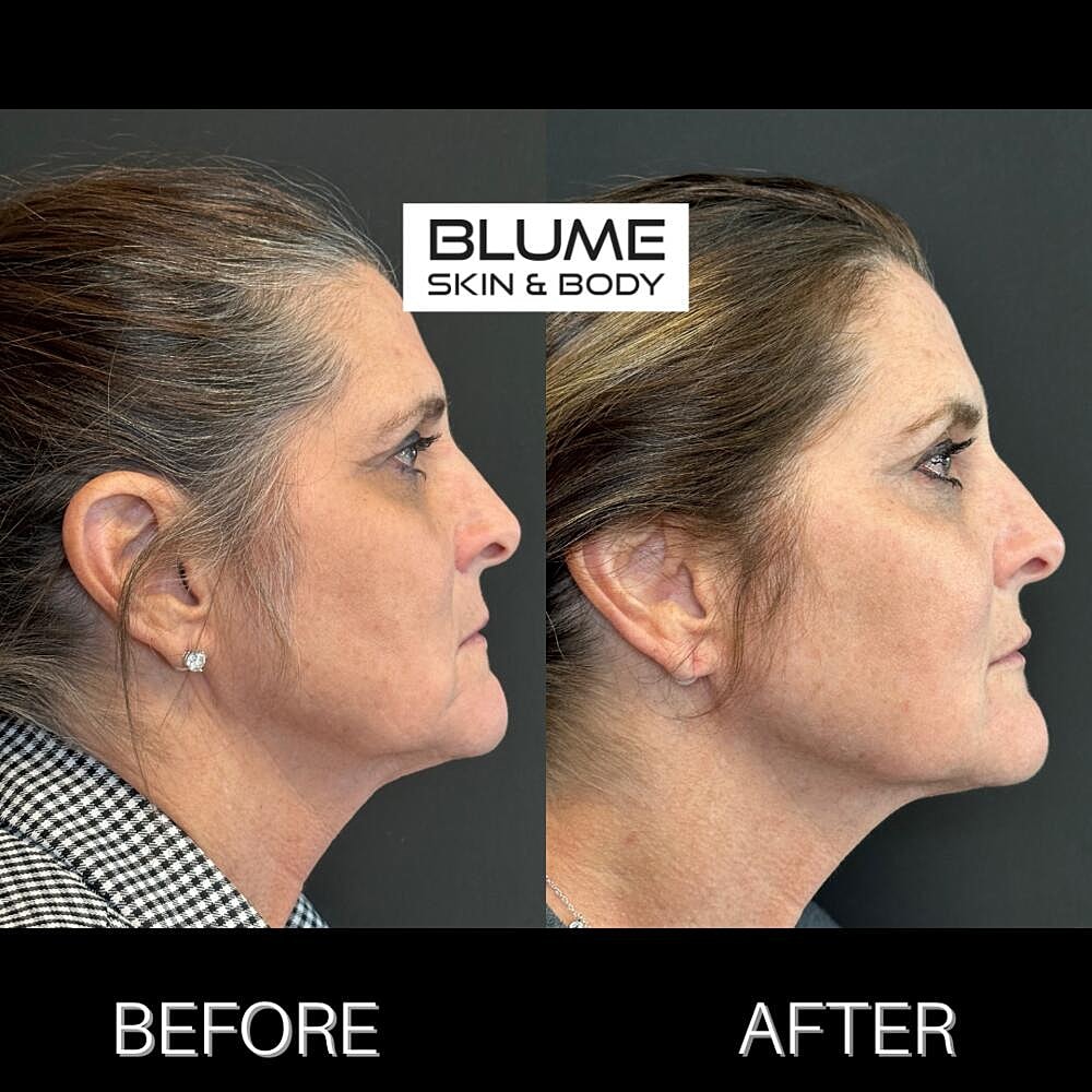 Dermal Fillers Before & After