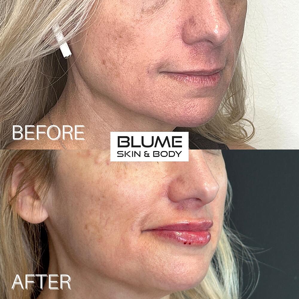 Dermal Fillers Before & After