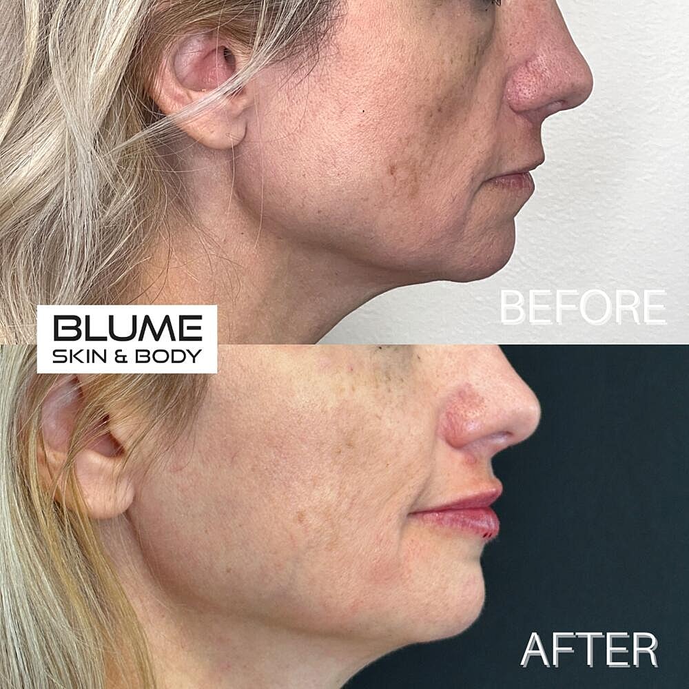 Dermal Fillers Before & After