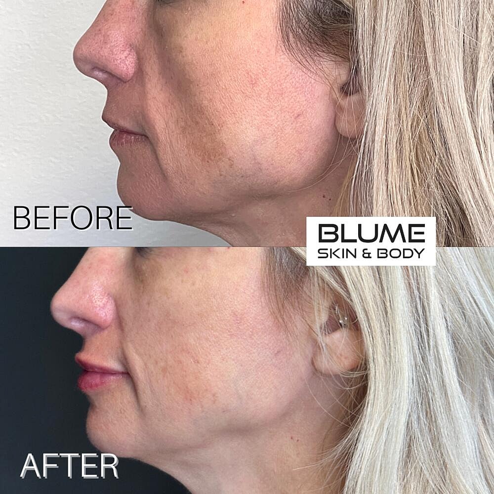 Dermal Fillers Before & After