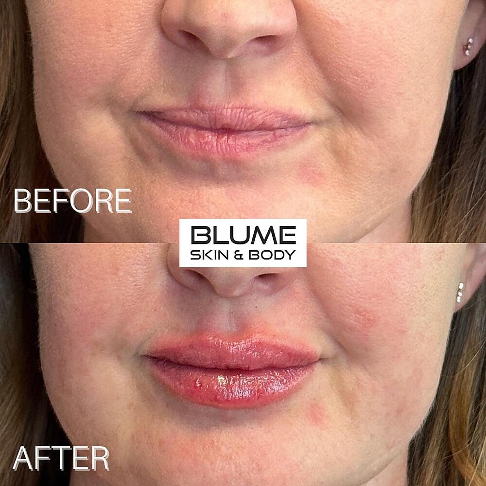 Dermal Fillers Before & After