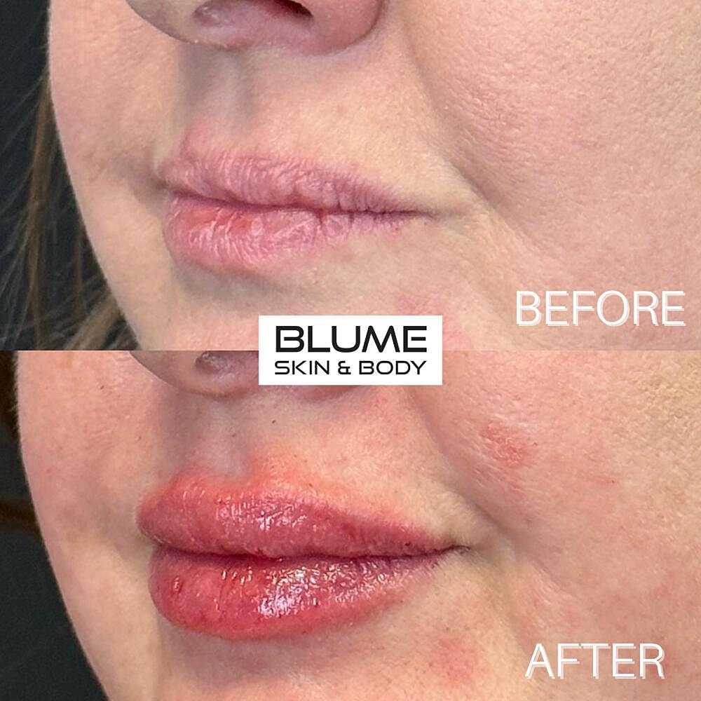 Dermal Fillers Before & After