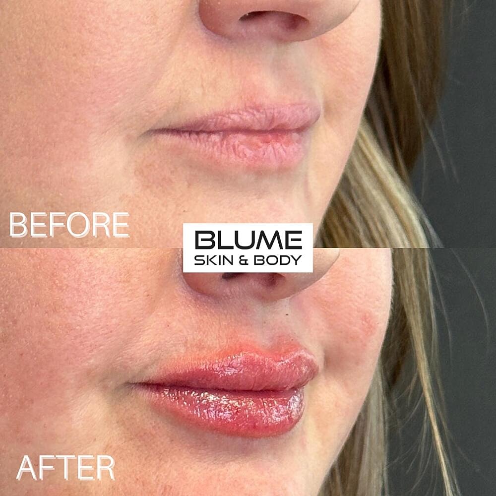 Dermal Fillers Before & After