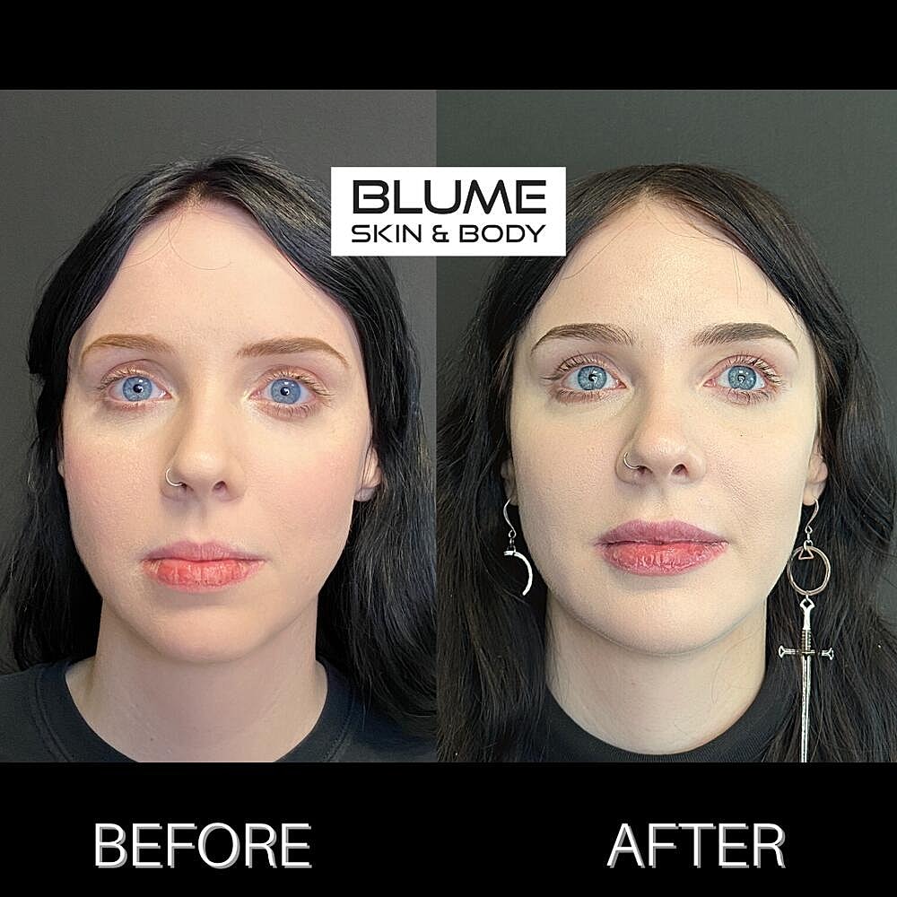 Dermal Fillers Before & After