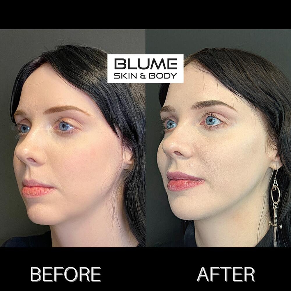 Dermal Fillers Before & After