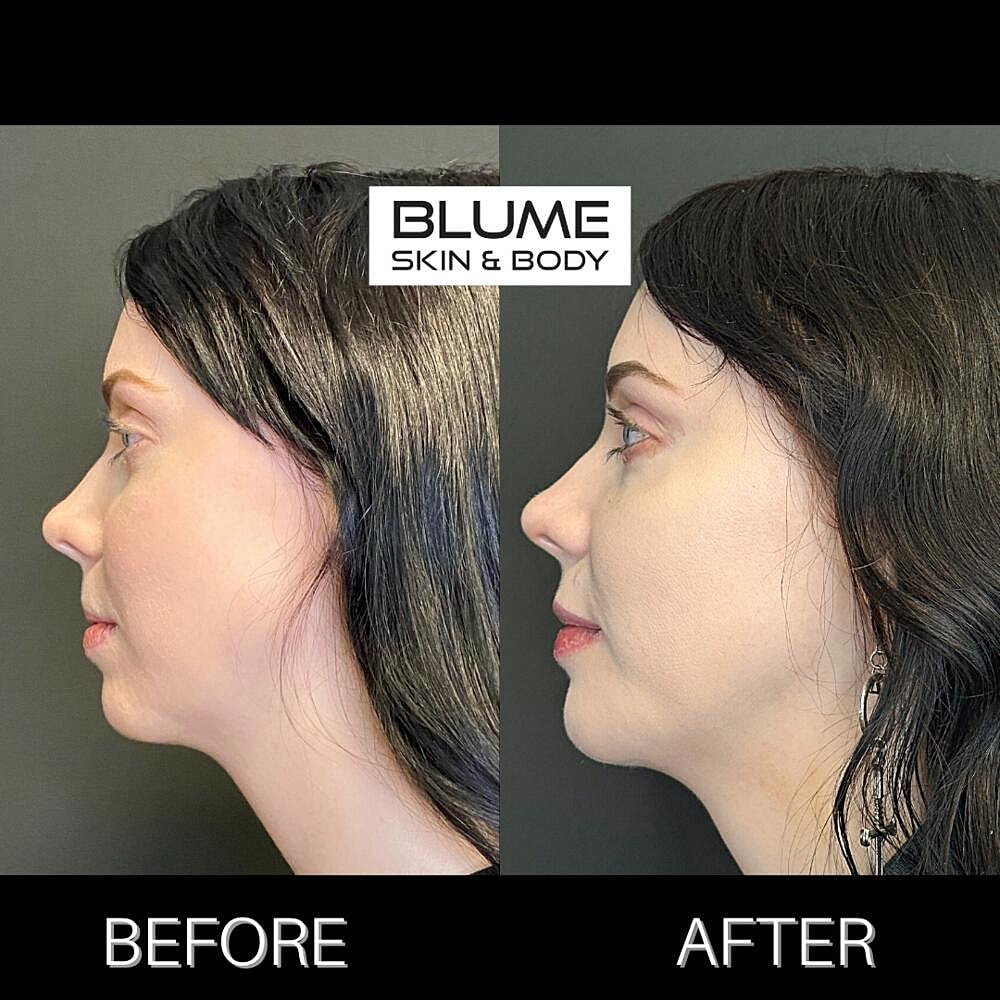 Dermal Fillers Before & After