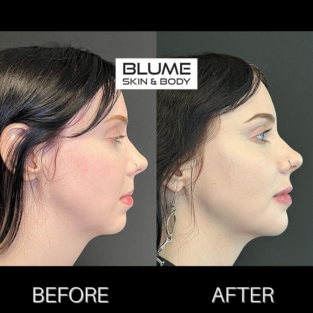 Dermal Fillers Before & After