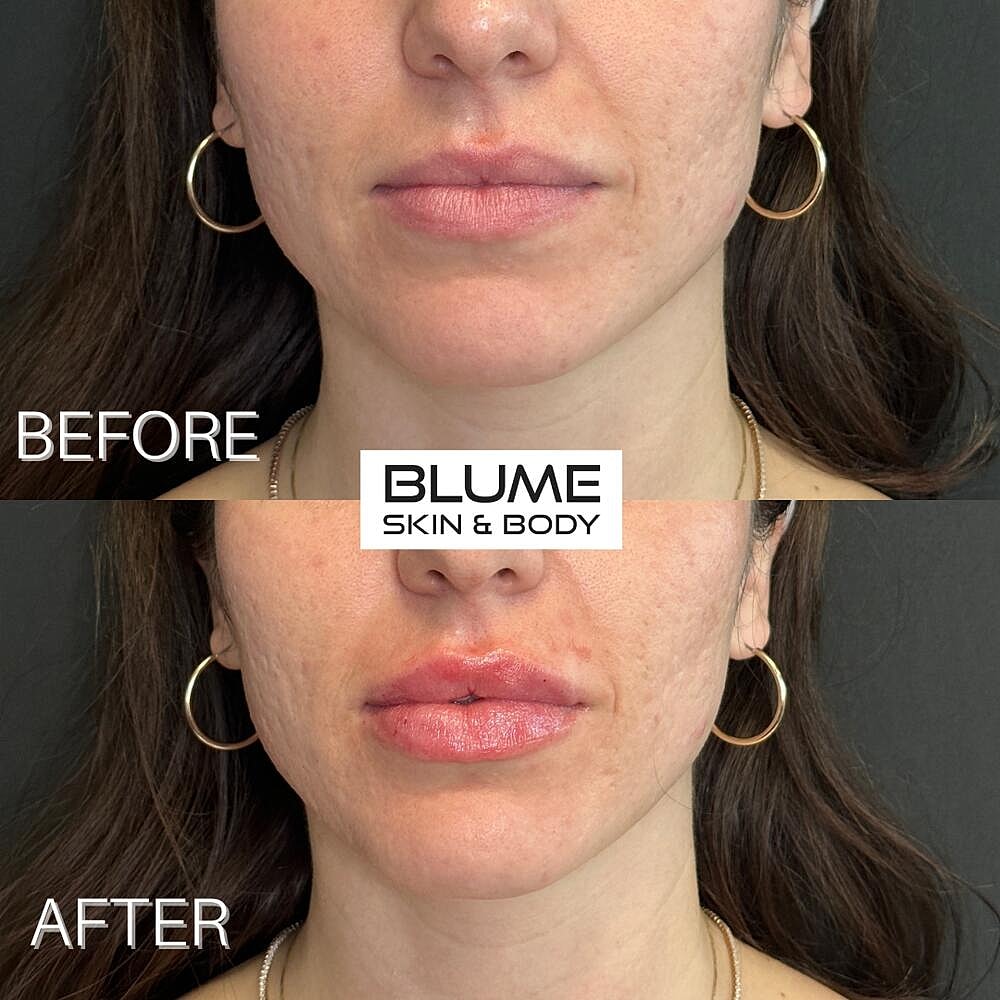 Dermal Fillers Before & After