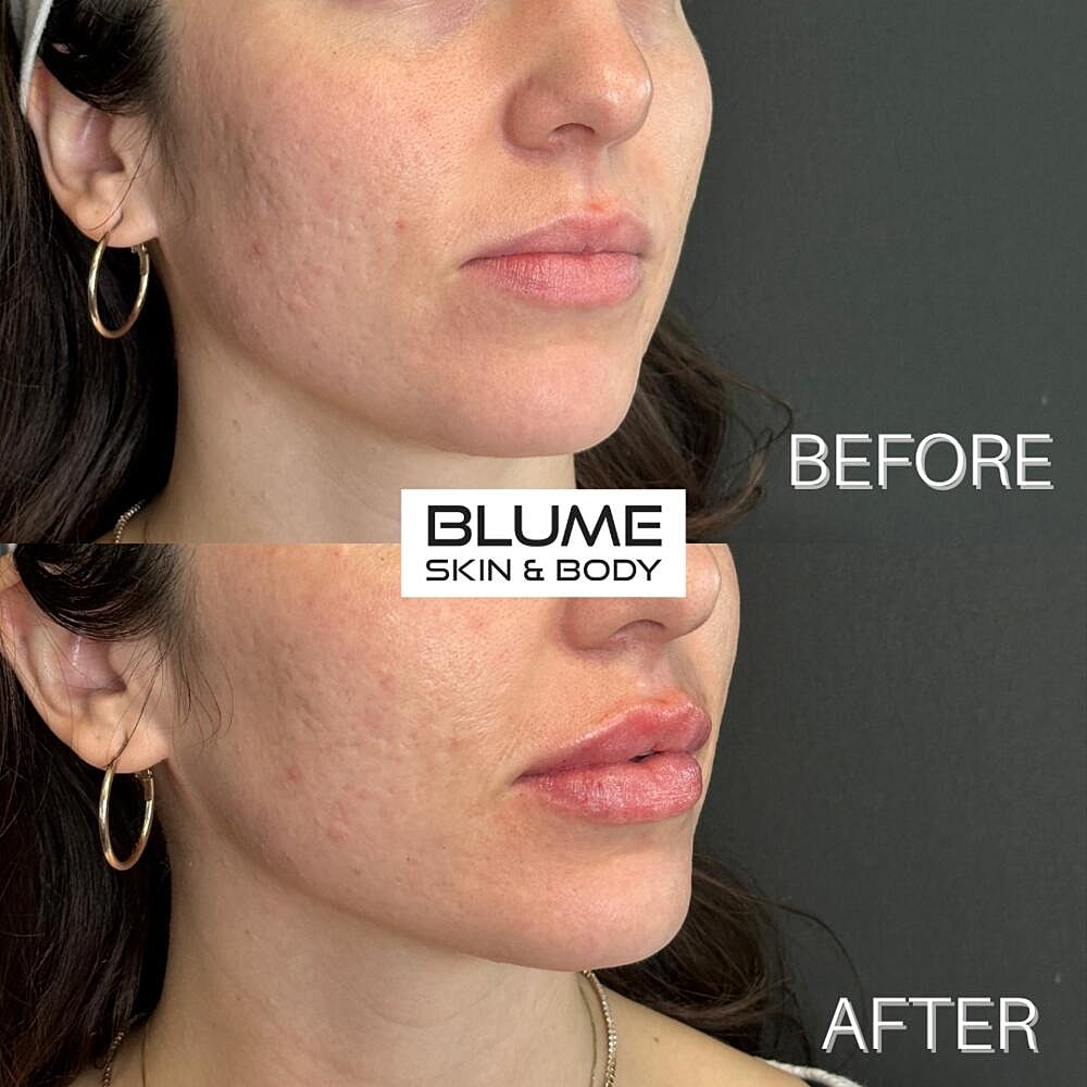 Dermal Fillers Before & After
