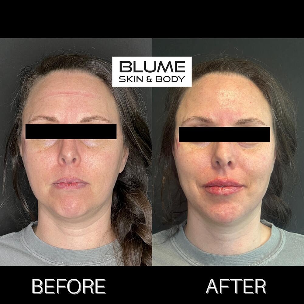 Dermal Fillers Before & After